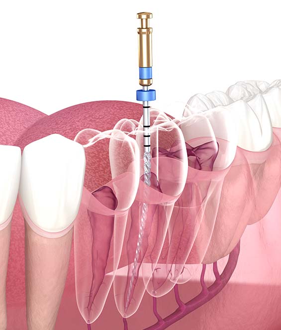 Endodontics in Downtown Dartmouth Peter Zwicker Dental Services
